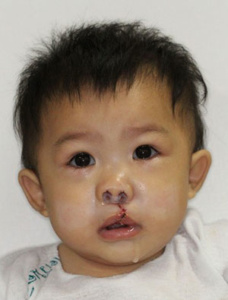 face of young child with cleft